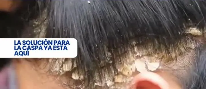 Descamación por caspa